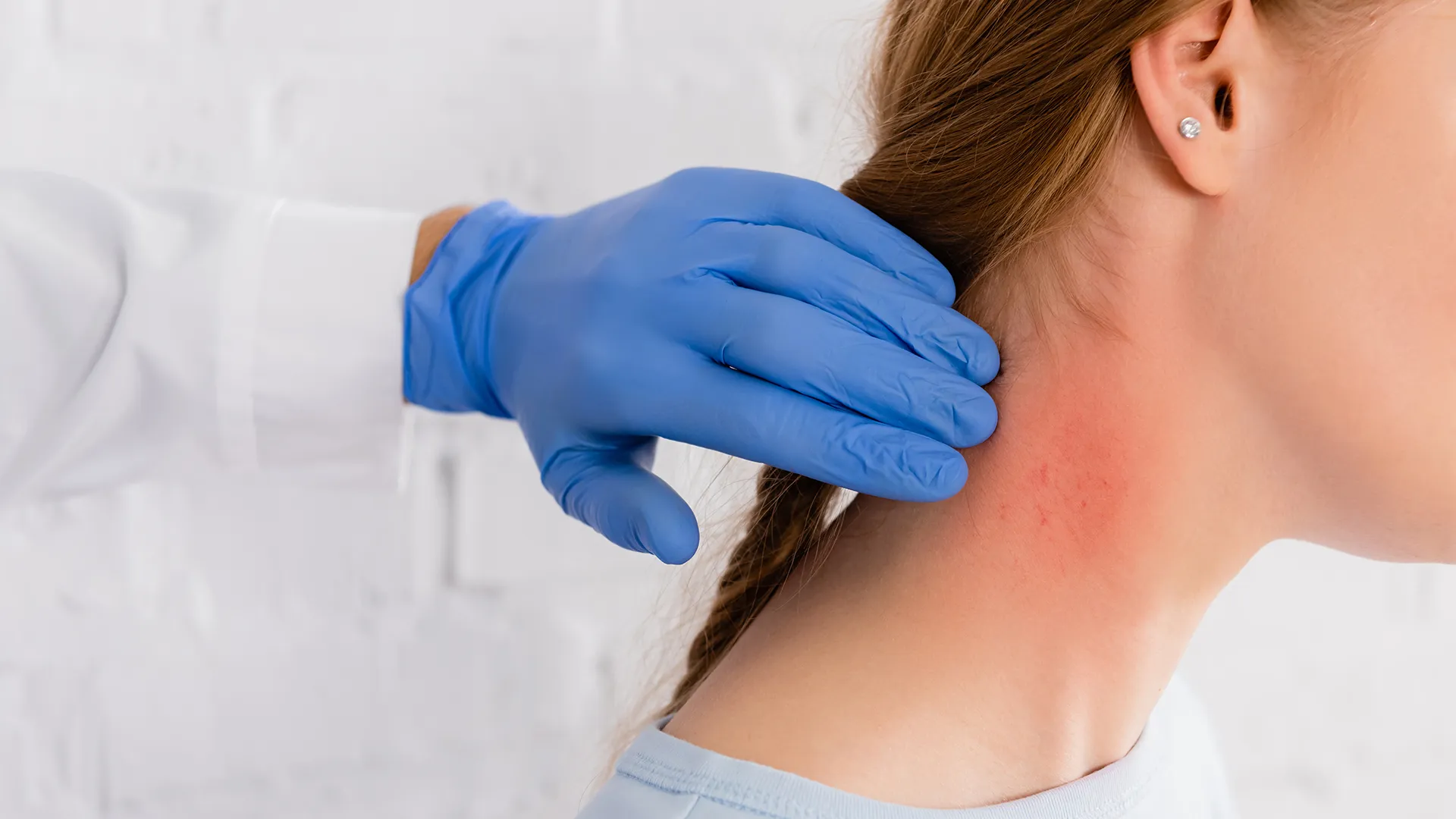 Systemic Lupus Erythematosus