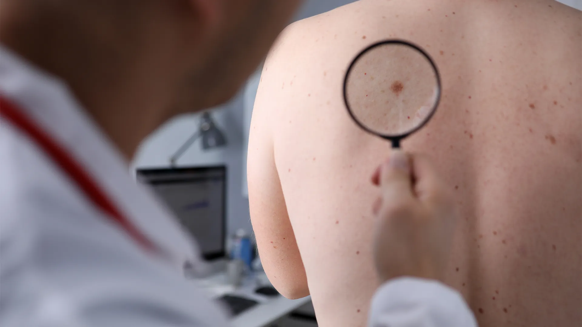 Systemic Lupus Erythematosus